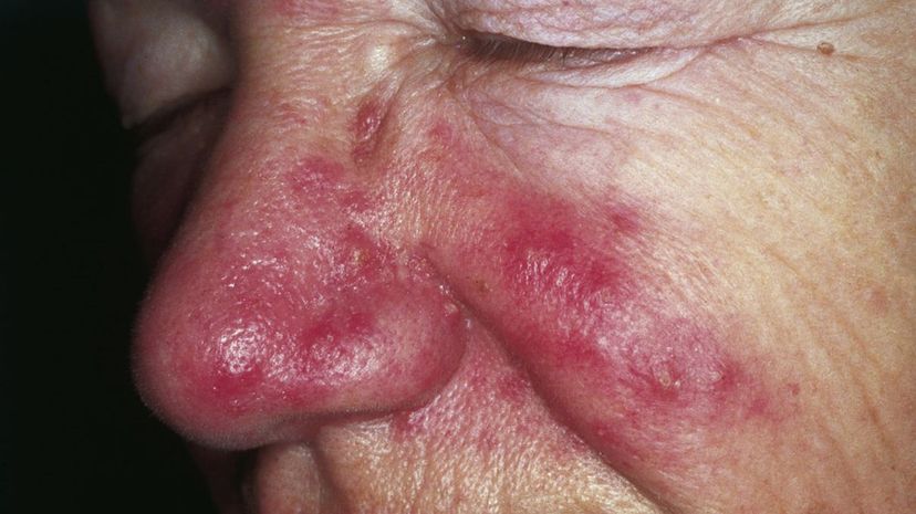 Question 15 - Rosacea