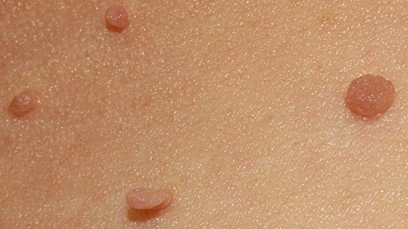 Question 1 - Skin tags