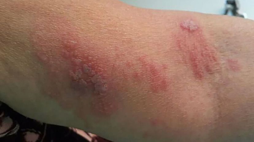 Question 13 - Shingles