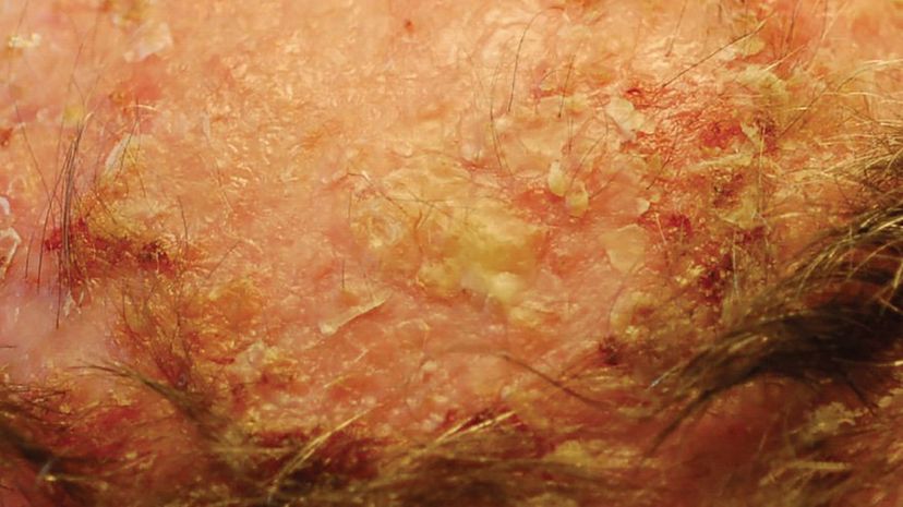 Question 18 - Actinic keratosis