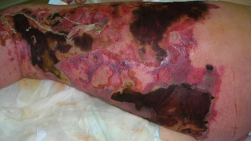 Question 32 - Necrotizing fasciitis