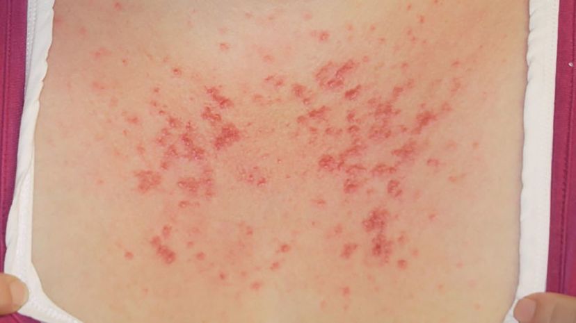 Question 38 - Polymorphic light eruption