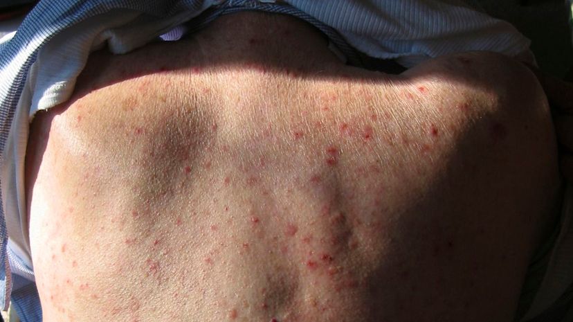 Question 37 - Bullous pemphigoid