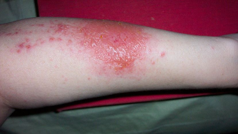 Question 24 - Contact dermatitis