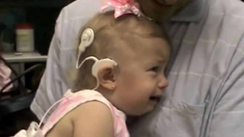 Cochlear Implant