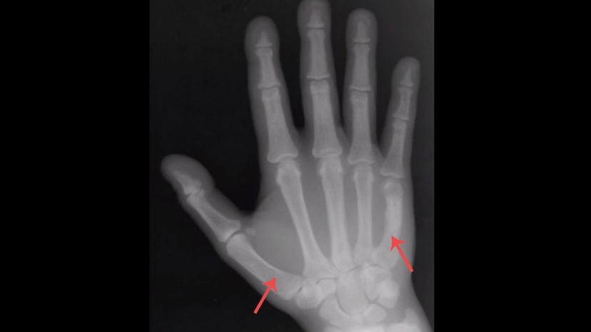 Metacarpals