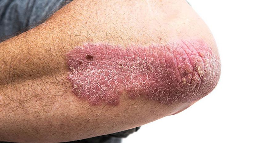 Question 6 - Psoriasis
