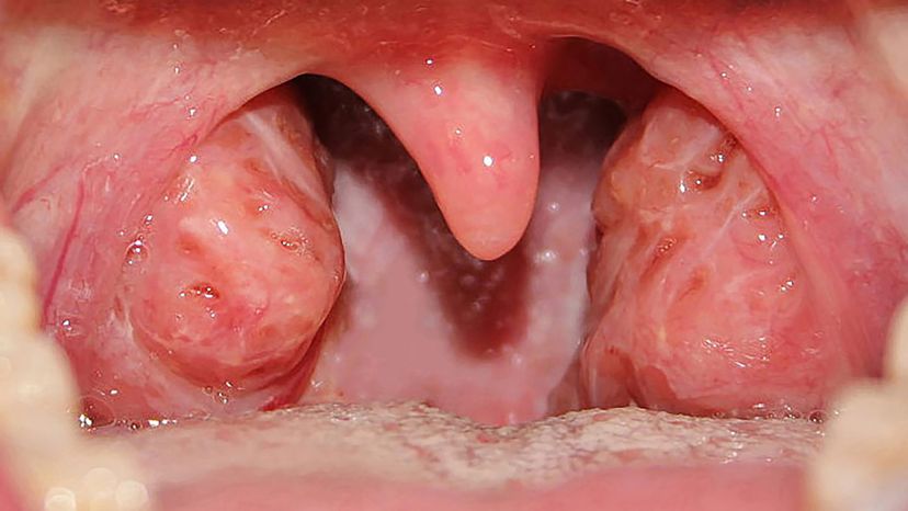 Tonsils