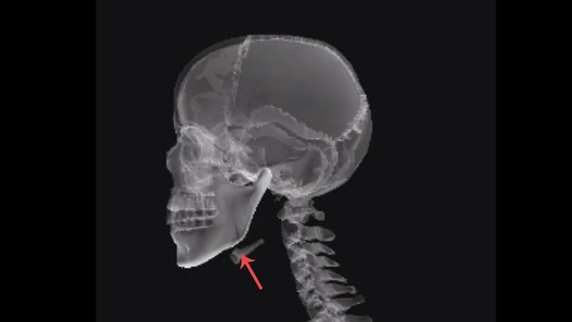 Hyoid bone