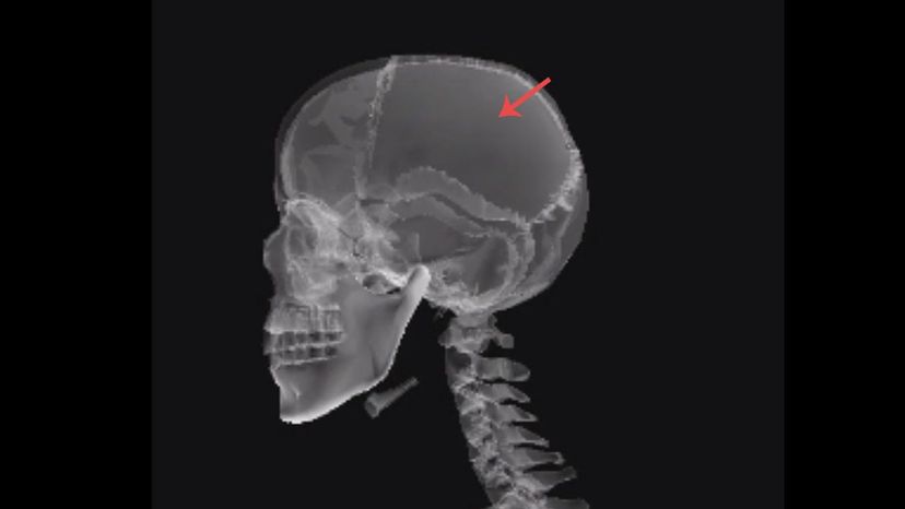 Parietal bone