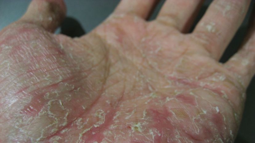 Question 33 - Peeling skin syndrome