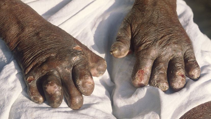 Question 30 - Leprosy