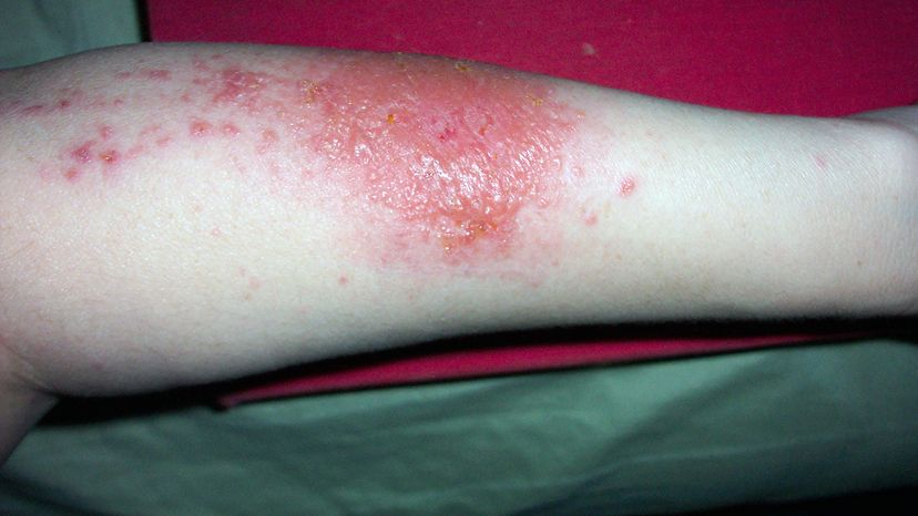 poison ivy rash