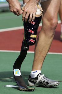 Modern Prosthetic Limbs