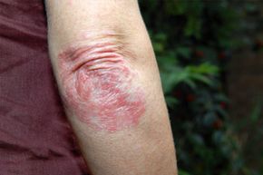 Psoriasis is an autoimmune disorder that triggers the production of excess skin cells. See more pictures of skin problems.