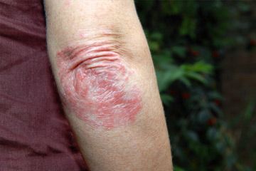 Psoriasis on a womans arm. Painful and itching skin condition.