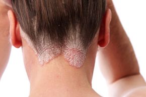 Psoriasis often manifests in red, inflamed skin at the nape of the neck. See more pictures of skin problems.