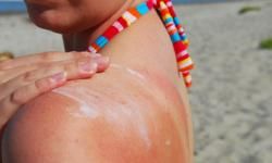 sunsburned shoulder
