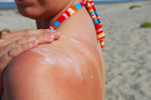 sunsburned shoulder