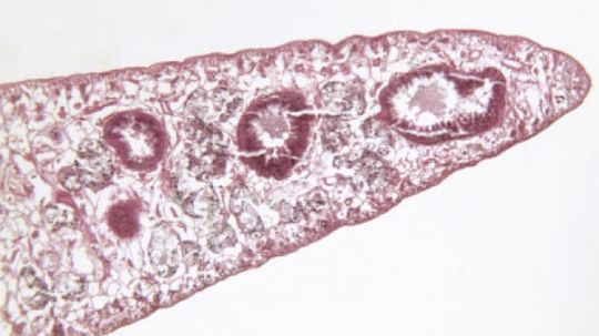 5 Rare Parasites Found in the Human Body