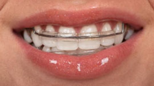 Get It Straight: The Teeth Retainers Quiz