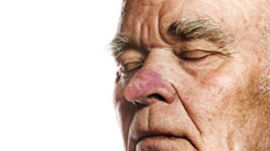 Rhinophyma Overview