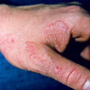 Tinea manus on hand. Fungus infection.