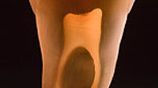 Root Canal Procedure