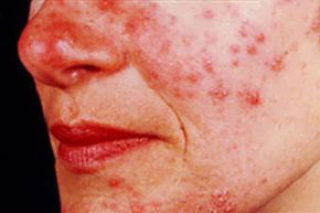 Rosacea is a chronic inflammation of the skin causing redness in the face and produces small, red, pus-filled bumps or pustules.