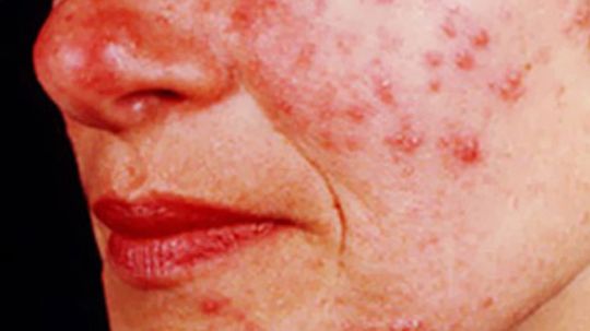 Rosacea Overview