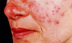 Rosacea is a chronic inflammation of the skin causing redness in the face.