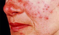 How to Identify a Skin Rash