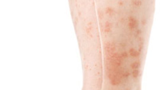 Statis Dermatitis Overview