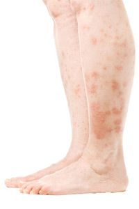 An itching skin condition all over the legs. .