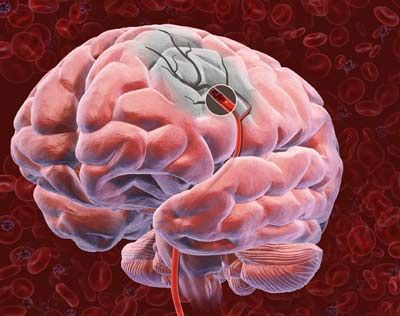 brain with blood clot