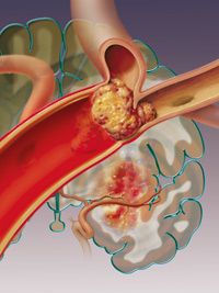 淤积的血块会引起缺血性中风。＂border=