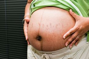 Stretch marks are a part of life. That doesn't mean you have to like them.