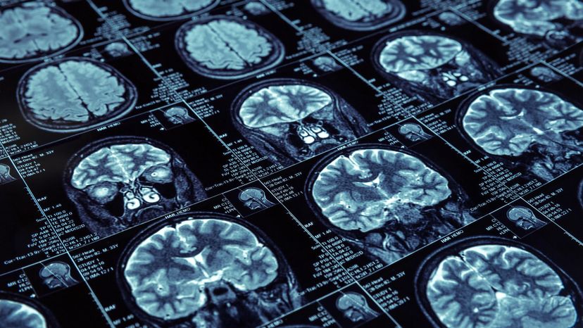 Researchers have used brain scans to try to figure how stuttering develops. Nomadsoul1/iStock/Thinkstock