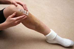 Bandages covering up healing knee injury.