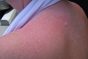 Sunburned skin with freckles and peeling.