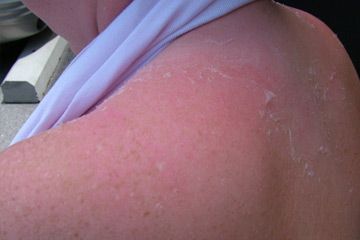 Sunburned skin with freckles and peeling.