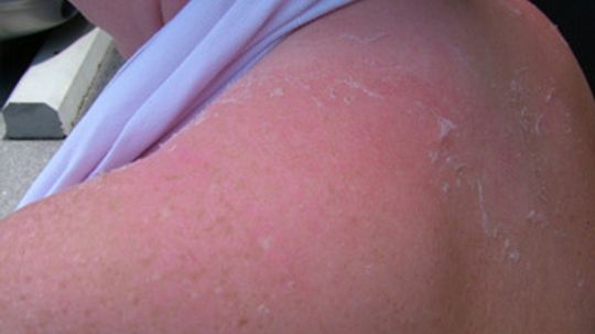 5 Things You Need To Know About Sun Rash Howstuffworks