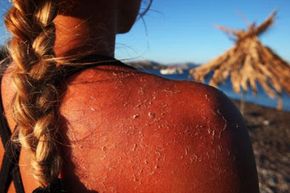 Sunburned skin peeling