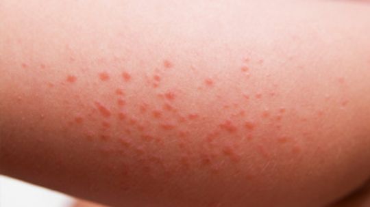 Understanding Skin Allergies