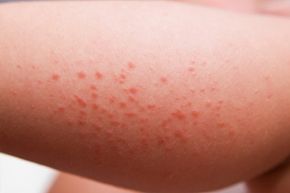 Skin allergies can cause itching and rashes.