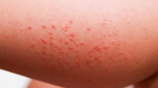 What are some different types of skin allergies?