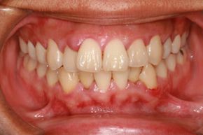 swollen gums