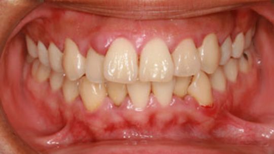 Is there a home remedy for swollen gums?