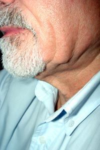 Close-up of older man's jawline and neck showing effects of aging and skin elasticity.