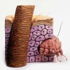 Model of Itch mite (Sarcoptes scabiei) burrowing inside human skin
